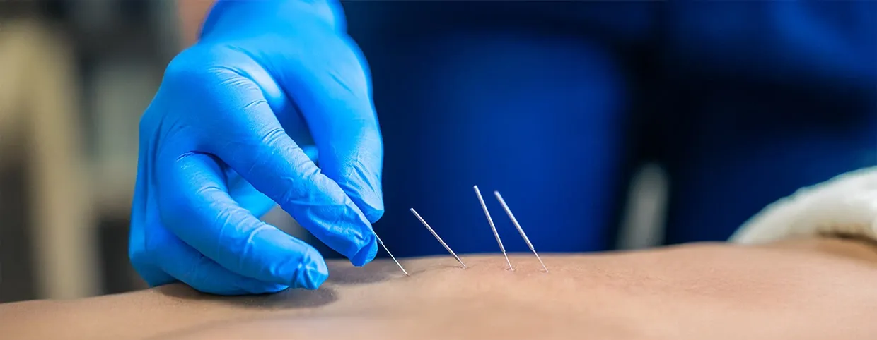 استكشاف العلاج بالوخز الجاف