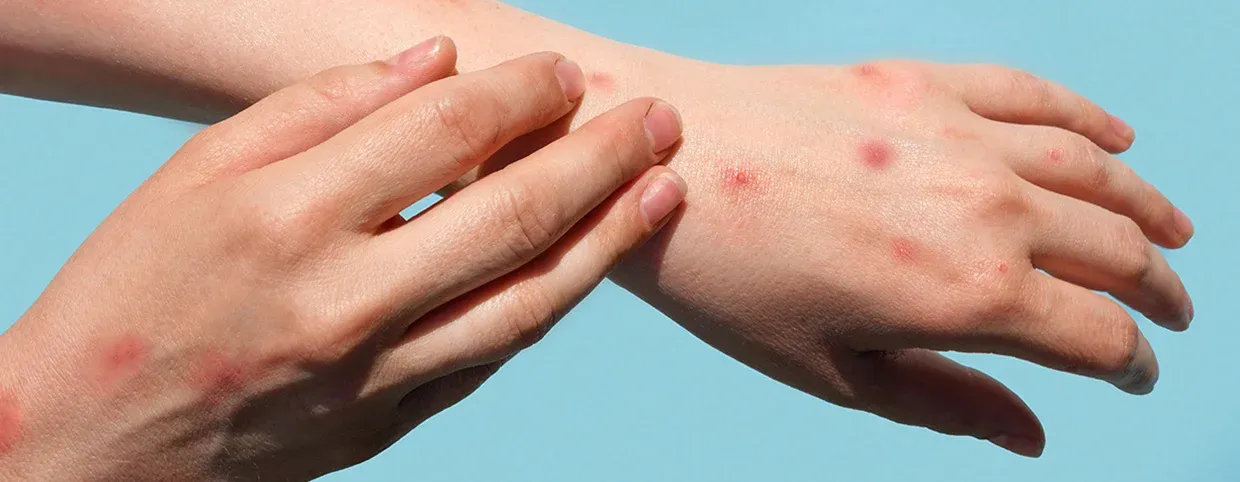 Recognizing Herpes Symptoms in Women