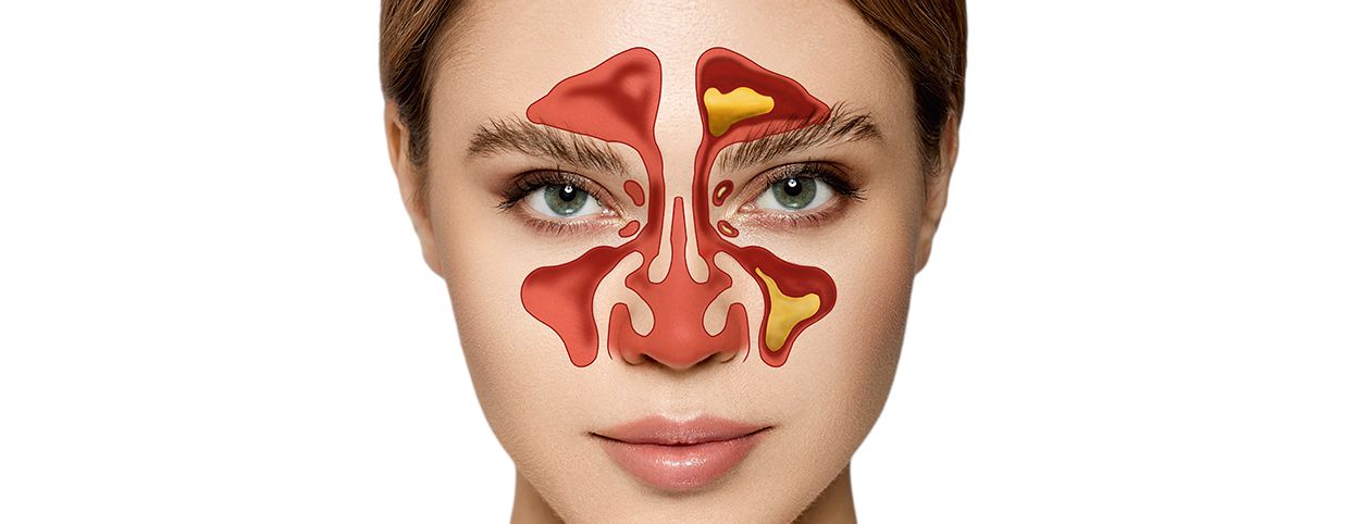 How Chronic Sinusitis Develops?: The Process
