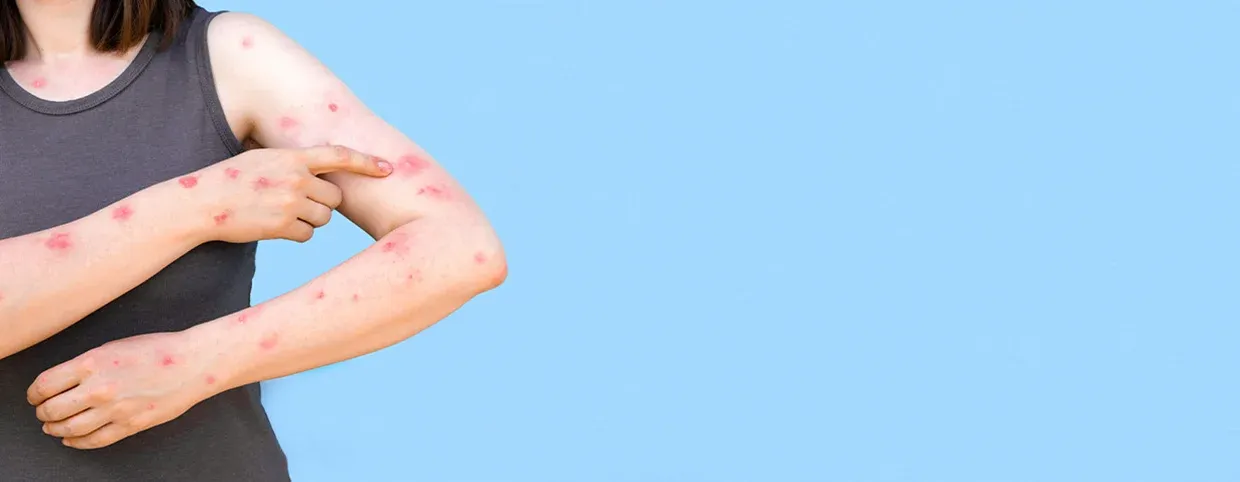 What Is Mpox (Previously Referred To As Monkeypox)?