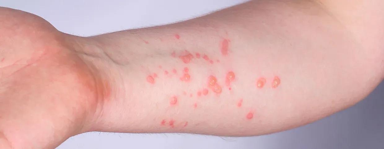 Signs And Symptoms Of Monkeypox