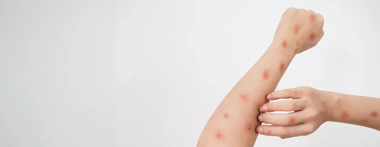 فهم مرض امبوكس: الخاتمة